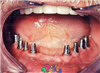 ایمپلنت دندان چیست  سری اول