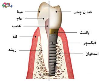 ایمپلنت دندان چیست سری دوم