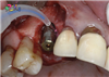 ایمپلنت دندان چیست  سری سوم