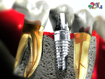 ایمپلنت دندان چیست سری چهارم